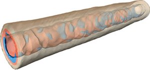 Visualisierung einer patientenspezifischen Arteriengeometrie