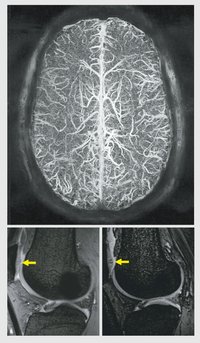 Venogram bei 7 Tesla